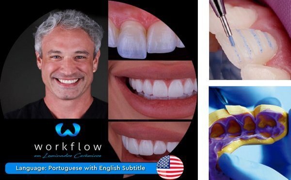 Ceramic-Veneers-Workflow.jpg